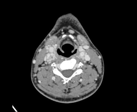 Bilateral carotid body tumors (Radiopaedia 61841-69870 Axial Post contrast 60).jpg