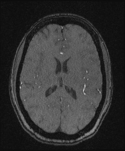 Bilateral carotid body tumors and right glomus jugulare tumor (Radiopaedia 20024-20060 Axial MRA 112).jpg