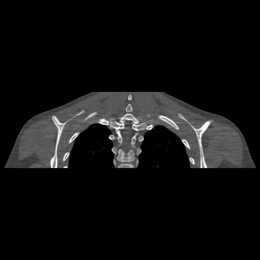 Bilateral chronic posterior shoulder dislocation (Radiopaedia 39213-41452 Coronal bone window 47).jpg