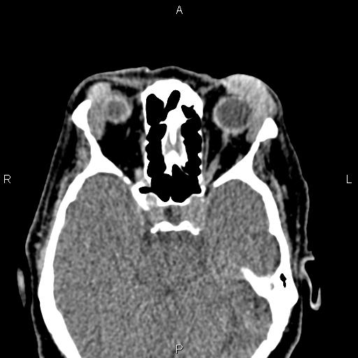 Bilateral enlargement of lacrimal glands - sarcoidosis (Radiopaedia 62627-70921 Axial non-contrast 51).jpg