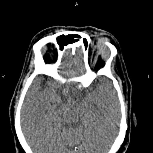 Bilateral enlargement of lacrimal glands - sarcoidosis (Radiopaedia 62627-70921 Axial non-contrast 60).jpg