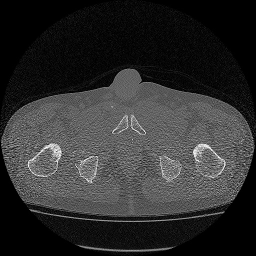 Bilateral femoral neck stress fractures (Radiopaedia 28666-28954 Axial bone window 70).png