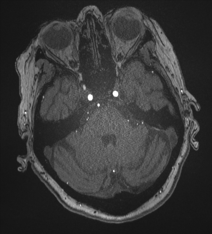Bilateral fetal posterior communicating arteries (Radiopaedia 41286-44102 Axial MRA 51).png