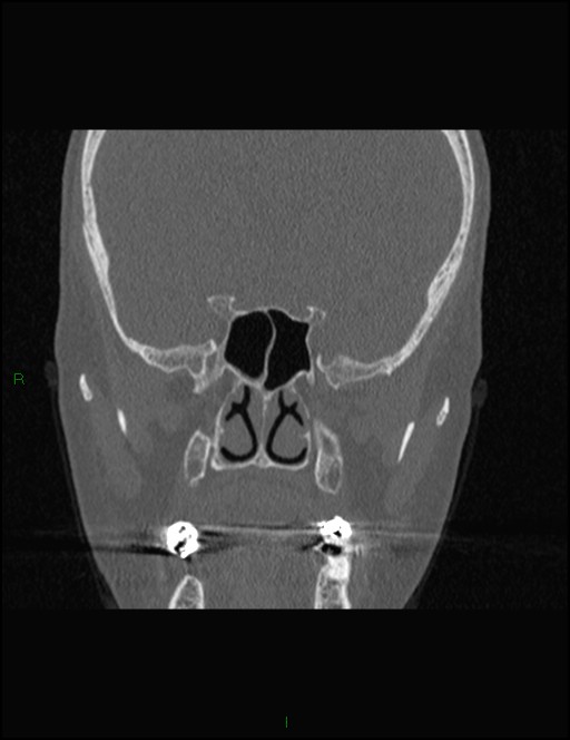 Bilateral frontal mucoceles (Radiopaedia 82352-96454 Coronal 199).jpg