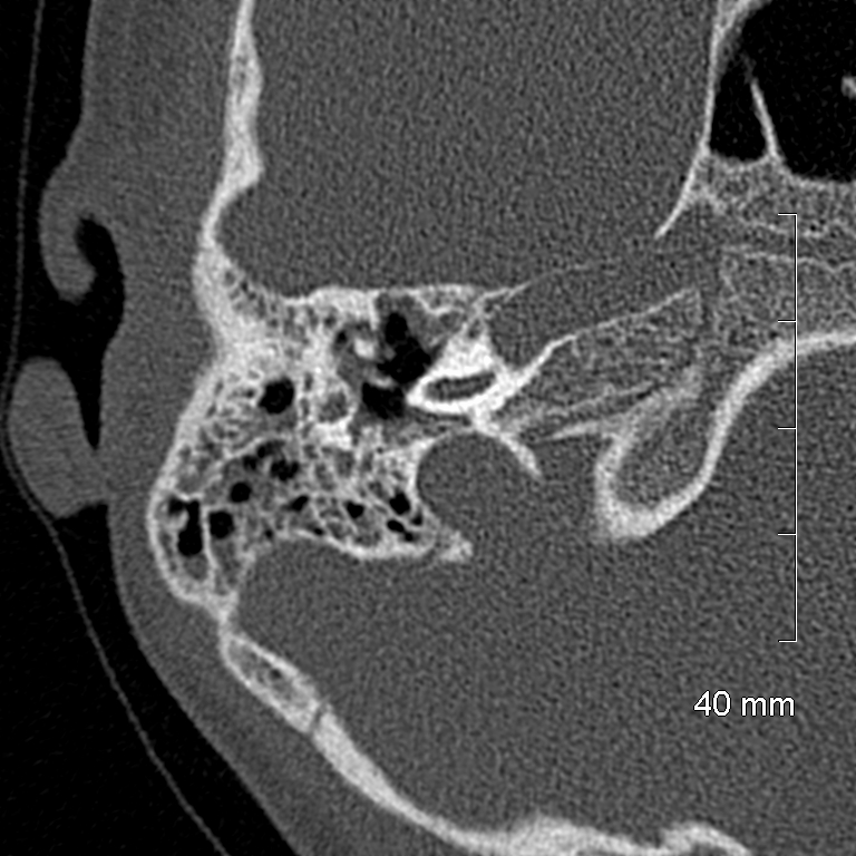Bilateral grommets (Radiopaedia 47710-52404 Axial bone window 33).jpg