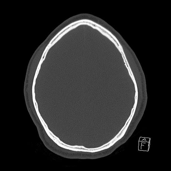 Bilateral occipital condyle fracture (type 2) (Radiopaedia 87675-104089 Axial bone window 97).jpg