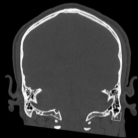 Bilateral occipital condyle fracture (type 2) (Radiopaedia 87675-104089 Coronal bone window 92).jpg