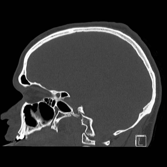 Bilateral occipital condyle fracture (type 2) (Radiopaedia 87675-104089 Sagittal bone window 68).jpg