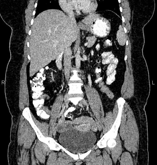Bilateral ovarian dermoid cysts (Radiopaedia 85785-101603 C 26).jpg