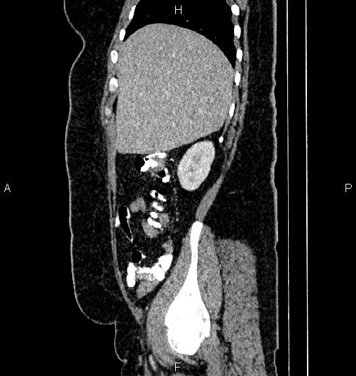 Bilateral ovarian dermoid cysts (Radiopaedia 85785-101603 D 16).jpg
