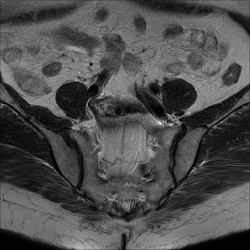 File:Bilateral ovarian dermoid cysts (Radiopaedia 90152-107338 Axial T2 4).jpg
