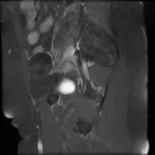 File:Bilateral ovarian dermoid cysts (Radiopaedia 90152-107338 Sagittal T1 C+ 20).jpg