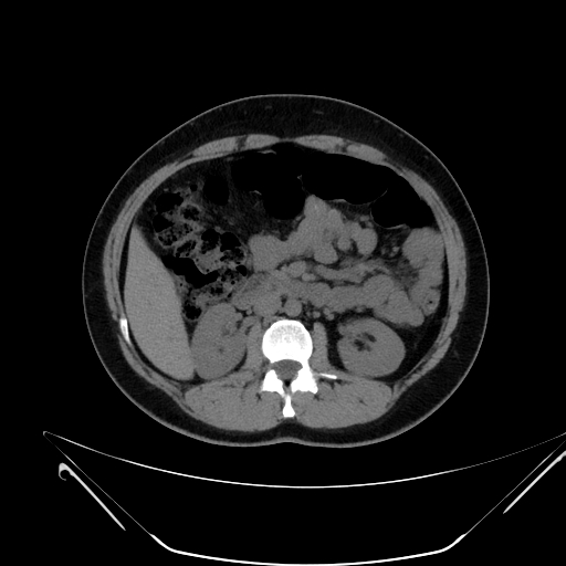 File:Bilateral ovarian mature cystic teratomas (Radiopaedia 79373-92457 Axial non-contrast 21).jpg
