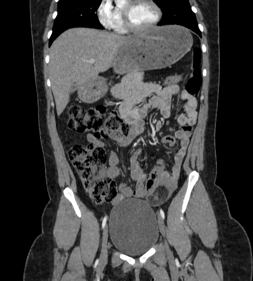 File:Bilateral ovarian mature cystic teratomas (Radiopaedia 79373-92457 B 20).jpg
