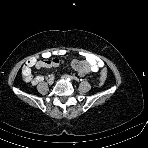 File:Bilateral ovarian serous cystadenocarcinoma (Radiopaedia 86062-101989 Axial C+ delayed 50).jpg