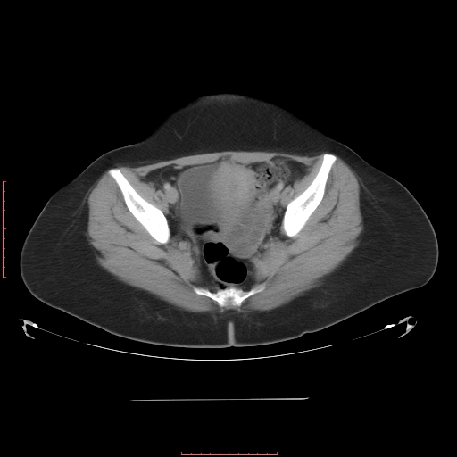 File:Bilateral ovarian serous cystadenocarcinoma with right ovarian torsion (Radiopaedia 32640-33611 A 37).jpg