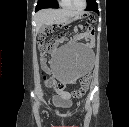 File:Bilateral ovarian serous cystadenocarcinoma with right ovarian torsion (Radiopaedia 32640-33611 C 1).jpg