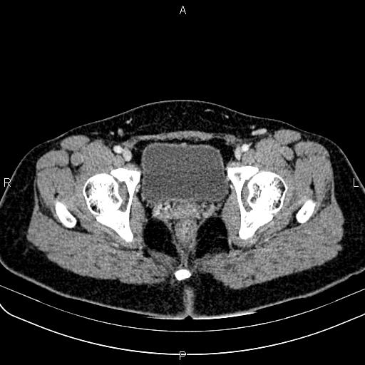 Bilateral ovarian teratoma (Radiopaedia 83131-97503 Axial With contrast 68).jpg