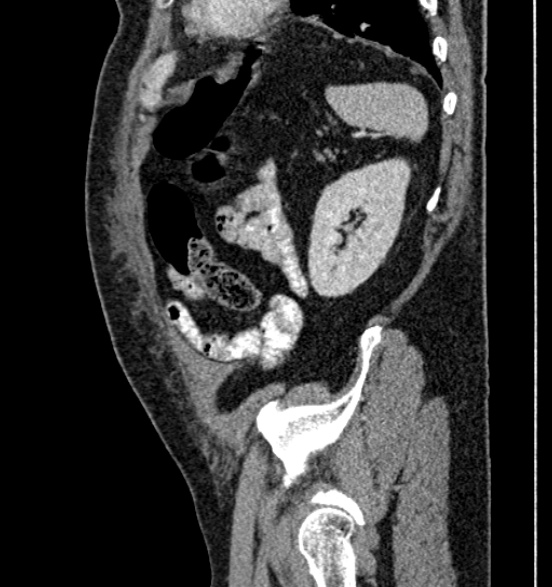 Bilateral rectus sheath hematomas (Radiopaedia 50778-56252 B 64).jpg