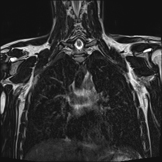 Bilateral spinoglenoid notch ganglion cysts (Radiopaedia 29577-30082 Coronal T2 67).jpg
