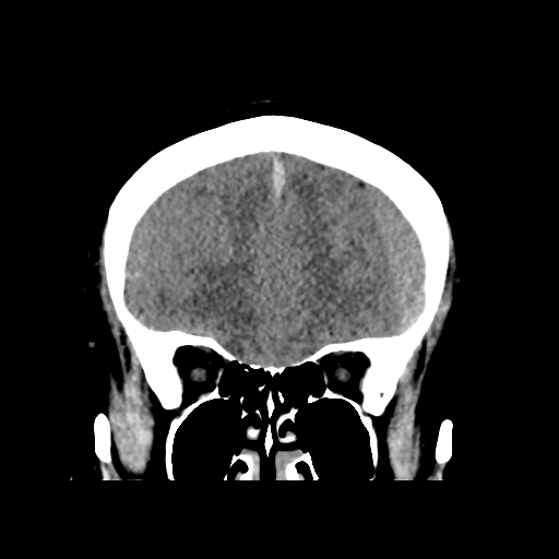 Bilateral subacute subdural hematoma (Radiopaedia 69240-79018 Coronal non-contrast 14).jpg
