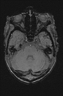File:Bilateral subdural hemorrhage and parietal skull fracture (Radiopaedia 26058-26190 Axial SWI 17).png