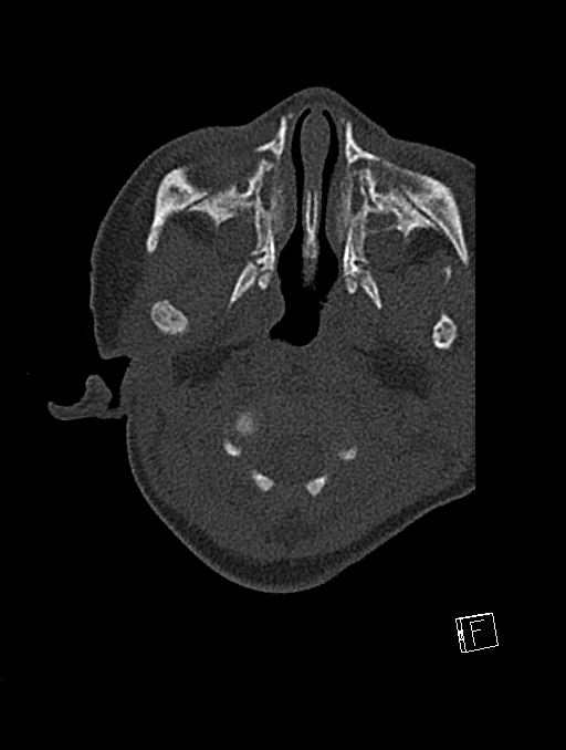 Bilateral subdural hemorrhage and parietal skull fracture (Radiopaedia 26058-26192 Axial bone window 121).png