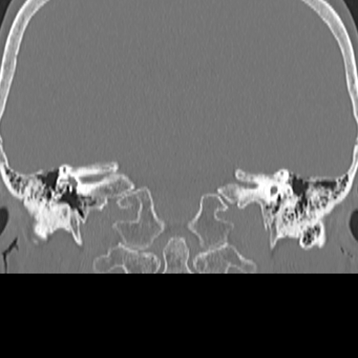 File:Bilateral tympanoplasty (Radiopaedia 16947-16664 Coronal bone window 15).jpg