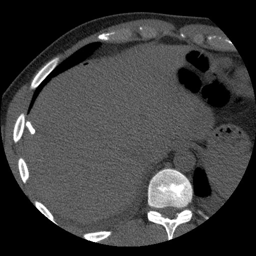 Bile leak from liver traumatic laceration (Radiopaedia 63463-72077 Axial Biliscopin 16).jpg