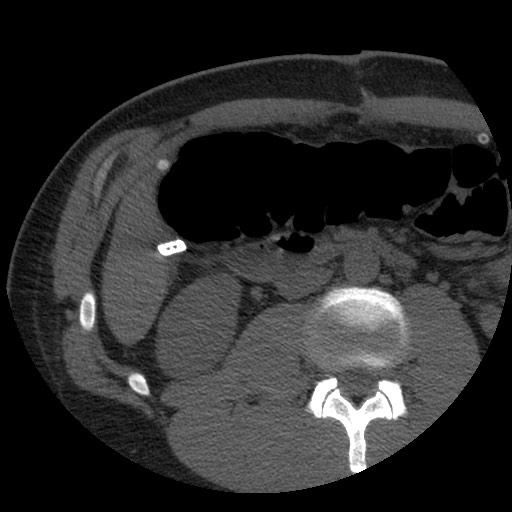 Bile leak from liver traumatic laceration (Radiopaedia 63463-72077 Axial Biliscopin 72).jpg