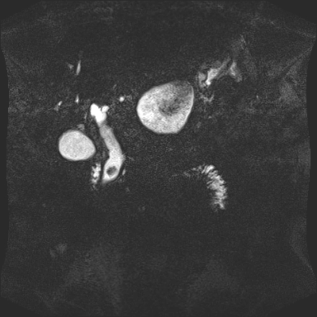 Biliary pancreatitis (Radiopaedia 72289-82824 Coronal 3D T2 45).jpg