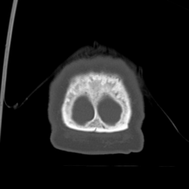 Biparietal osteodystrophy (Radiopaedia 46109-50463 Coronal bone window 103).jpg