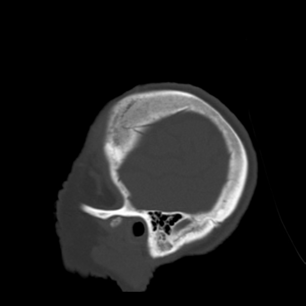 Biparietal osteodystrophy (Radiopaedia 46109-50463 Sagittal bone window 14).jpg