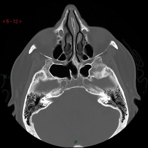 File:Bisphosphonate-related osteonecrosis of the jaw (Radiopaedia 54147-60329 Axial bone window 6).jpg