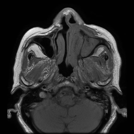 Bisphosphonate-related osteonecrosis of the maxilla (Radiopaedia 51367-57101 Axial T1 29).jpg