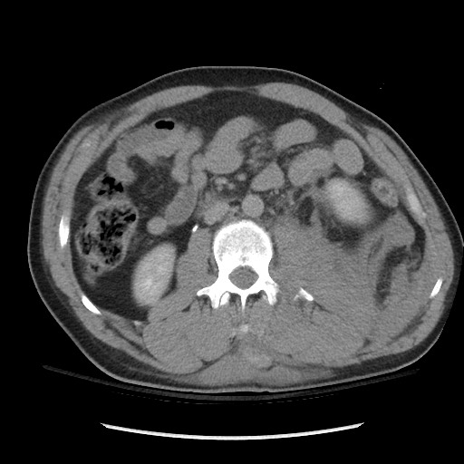 Blunt abdominal trauma with solid organ and musculoskelatal injury with active extravasation (Radiopaedia 68364-77895 Axial C+ delayed 66).jpg