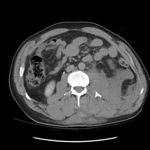 File:Blunt abdominal trauma with solid organ and musculoskelatal injury with active extravasation (Radiopaedia 68364-77895 Axial C+ delayed 68).jpg