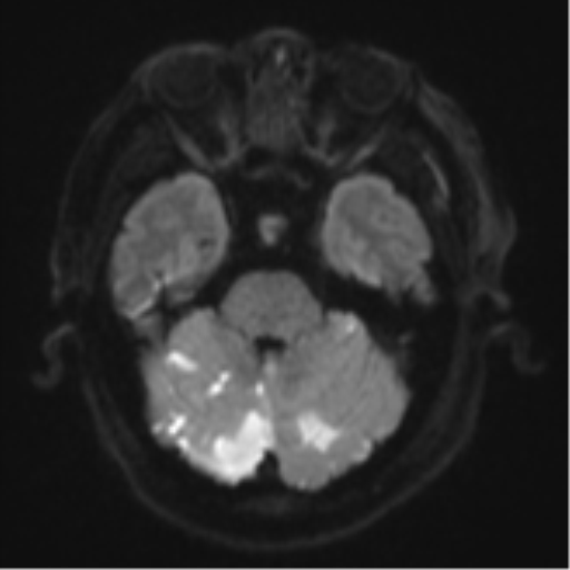 Blunt cerebrovascular injury (Radiopaedia 53682-59745 Axial DWI 40).png