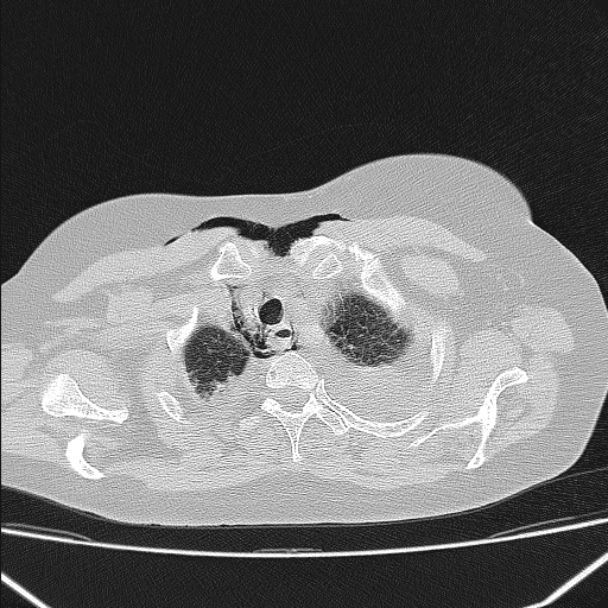 Boerhaave syndrome (Radiopaedia 45644-49799 Axial lung window 35).jpg