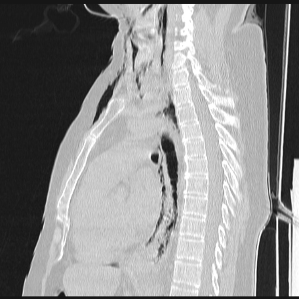 Boerhaave syndrome (Radiopaedia 45644-49799 Sagittal lung window 44).jpg