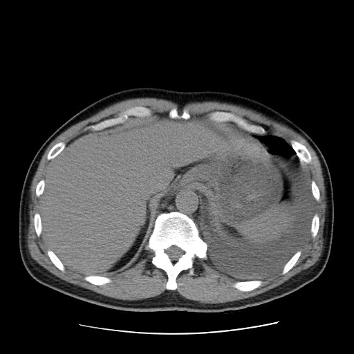 Boerhaave syndrome (Radiopaedia 59796-67310 Axial liver window 56).jpg