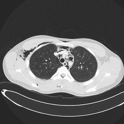 Boerhaave syndrome with mediastinal, axillary, neck and epidural free gas (Radiopaedia 41297-44115 Axial lung window 38).jpg