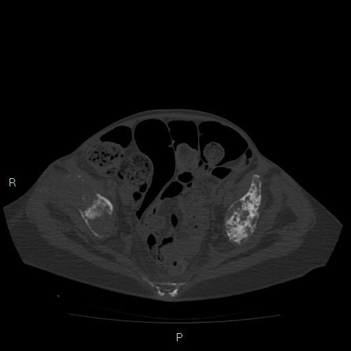 Bone metastases from untreated breast cancer (Radiopaedia 42973-46219 Axial bone window 170).jpg
