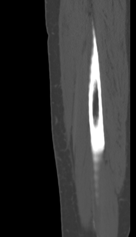 Bone metastasis - tibia (Radiopaedia 57665-64609 Sagittal bone window 171).jpg