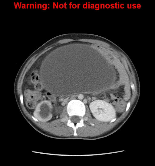 Borderline mucinous cystadenoma of ovary (Radiopaedia 25586-25767 A 13).jpg