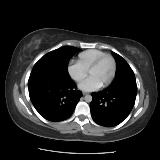 File:Borderline mucinous tumor (ovary) (Radiopaedia 78228-90808 A 57).jpg