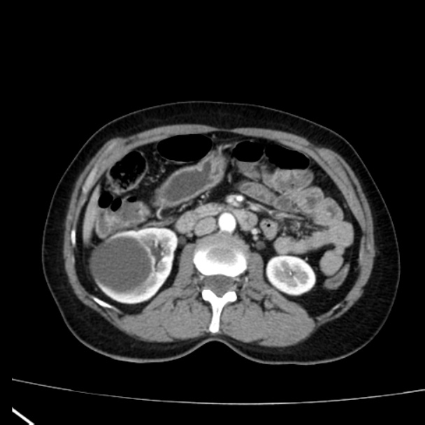 Bosniak renal cyst - type I (Radiopaedia 27479-27675 renal cortical phase 37).jpg