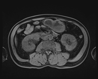 Bouveret syndrome (Radiopaedia 61017-68856 Axial T1 fat sat 49).jpg