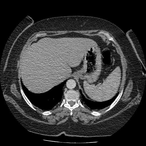 Bovine aortic arch - right internal mammary vein drains into the superior vena cava (Radiopaedia 63296-71875 A 147).jpg