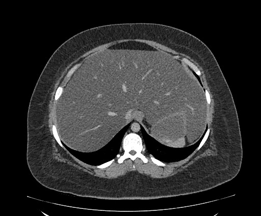 Bowel and splenic infarcts in acute lymphocytic leukemia (Radiopaedia 61055-68913 A 29).jpg